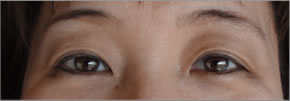 眼瞼下垂：術後2