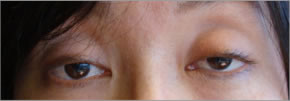 眼瞼下垂：術前1